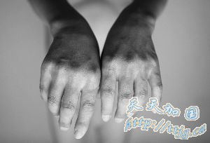 “自述阴性艾滋病者”未患传染病(组图)